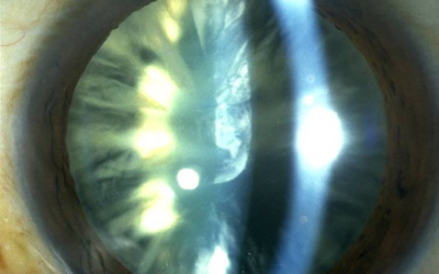 What to expect when having cataract surgery